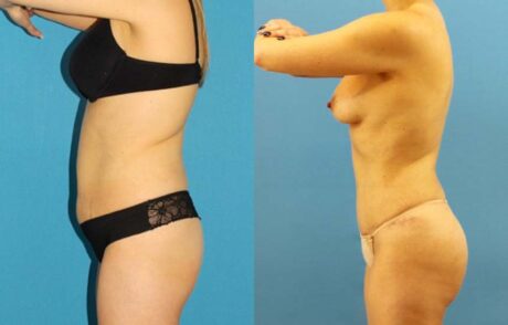 Tummy Tuck case #7343