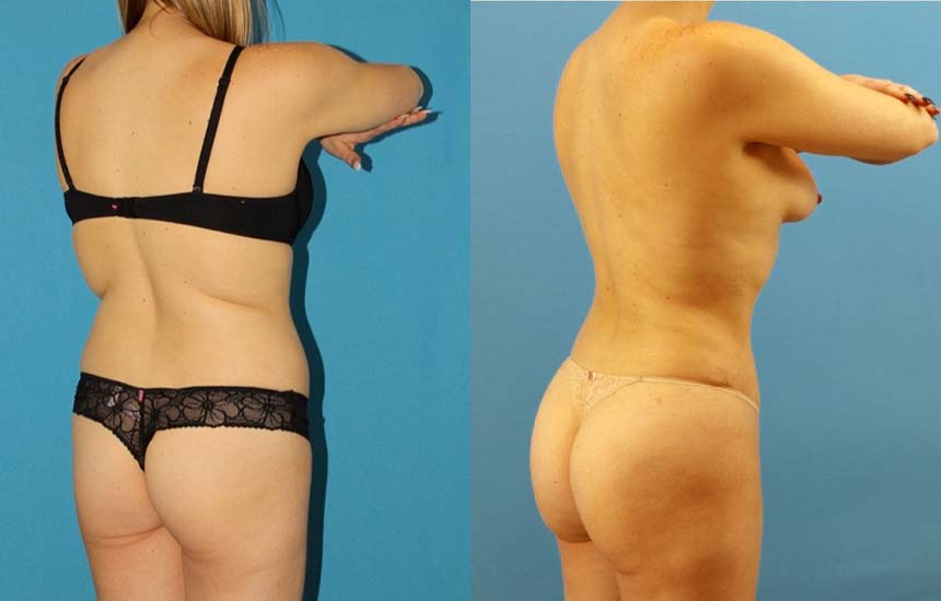 Tummy Tuck case #7343