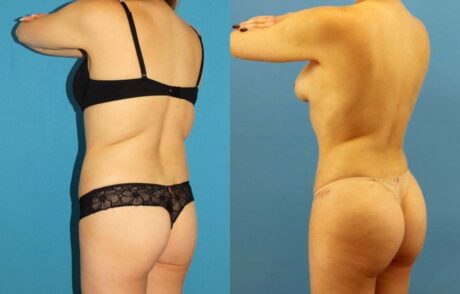 Tummy Tuck case #7343