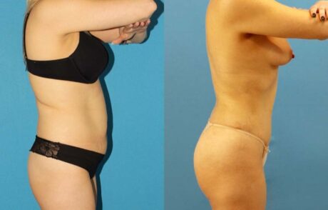 Tummy Tuck case #7343