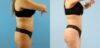 Brazilian Butt Lift case #4903 slider thumbnail