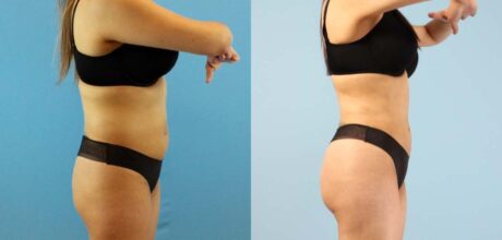 Brazilian Butt Lift case #4903