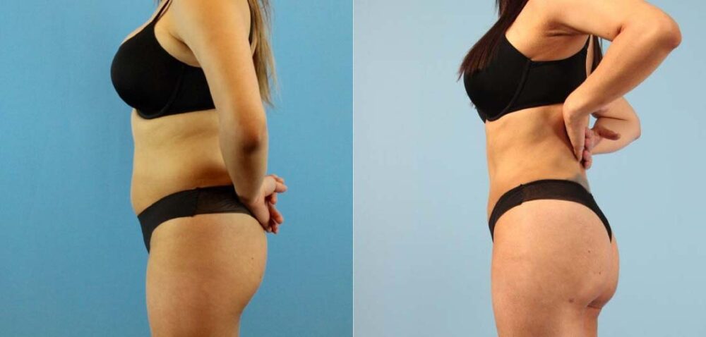 Brazilian Butt Lift case #4903