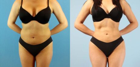 Brazilian Butt Lift case #4903