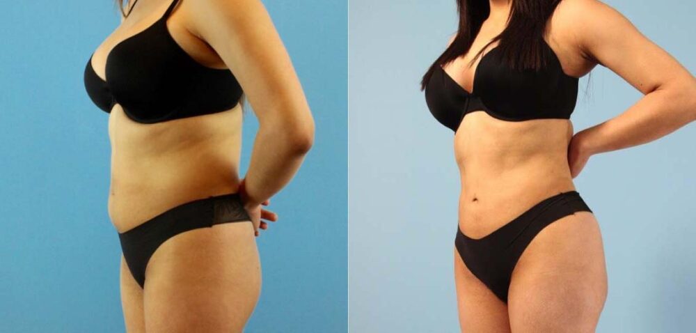 Brazilian Butt Lift case #4903