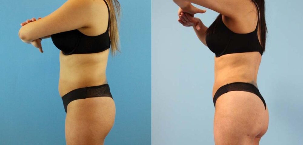 Brazilian Butt Lift case #4903