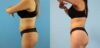 Brazilian Butt Lift case #4903 slider thumbnail