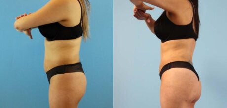 Brazilian Butt Lift case #4903