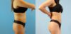 Brazilian Butt Lift case #4903 slider thumbnail