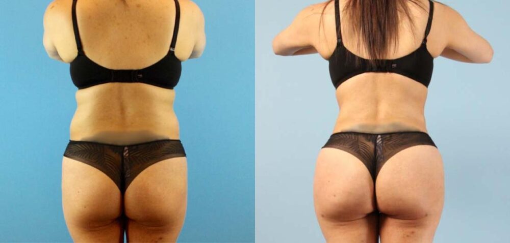 Brazilian Butt Lift case #4903