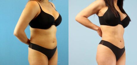 Brazilian Butt Lift case #4903