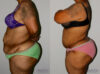 Post Bariatric Surgery (Massive Weight Loss) case #6773 slider thumbnail