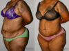 Post Bariatric Surgery (Massive Weight Loss) case #6773 slider thumbnail
