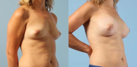 Breast Augmentation case #6303