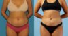 Liposuction case #5967 slider thumbnail