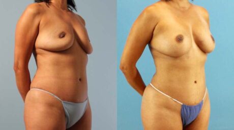 Implant Removal case #258479