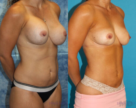 Implant Removal case #258481