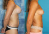 Implant Removal case #258481 slider thumbnail
