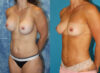 Implant Removal case #258481 slider thumbnail
