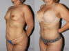 Post Bariatric Surgery (Massive Weight Loss) case #6772 slider thumbnail