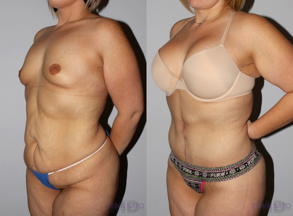 Post Bariatric Surgery (Massive Weight Loss) case #6772
