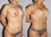Post Bariatric Surgery (Massive Weight Loss) case #6772 slider thumbnail