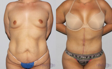 Post Bariatric Surgery (Massive Weight Loss) case #6772