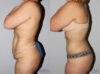 Post Bariatric Surgery (Massive Weight Loss) case #6772 slider thumbnail