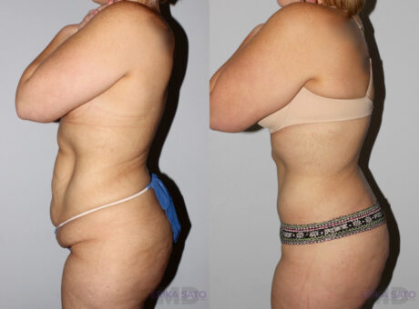 Post Bariatric Surgery (Massive Weight Loss) case #6772