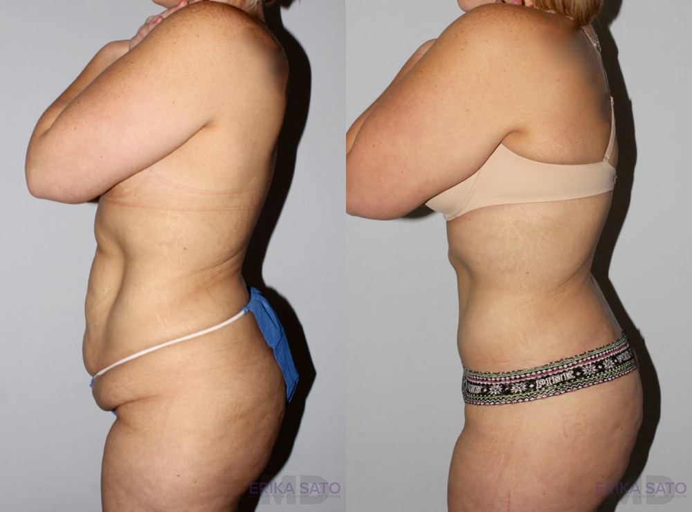 Post Bariatric Surgery (Massive Weight Loss) case #6772