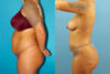 Tummy Tuck case #7344 slider thumbnail