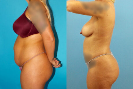 Tummy Tuck case #7344