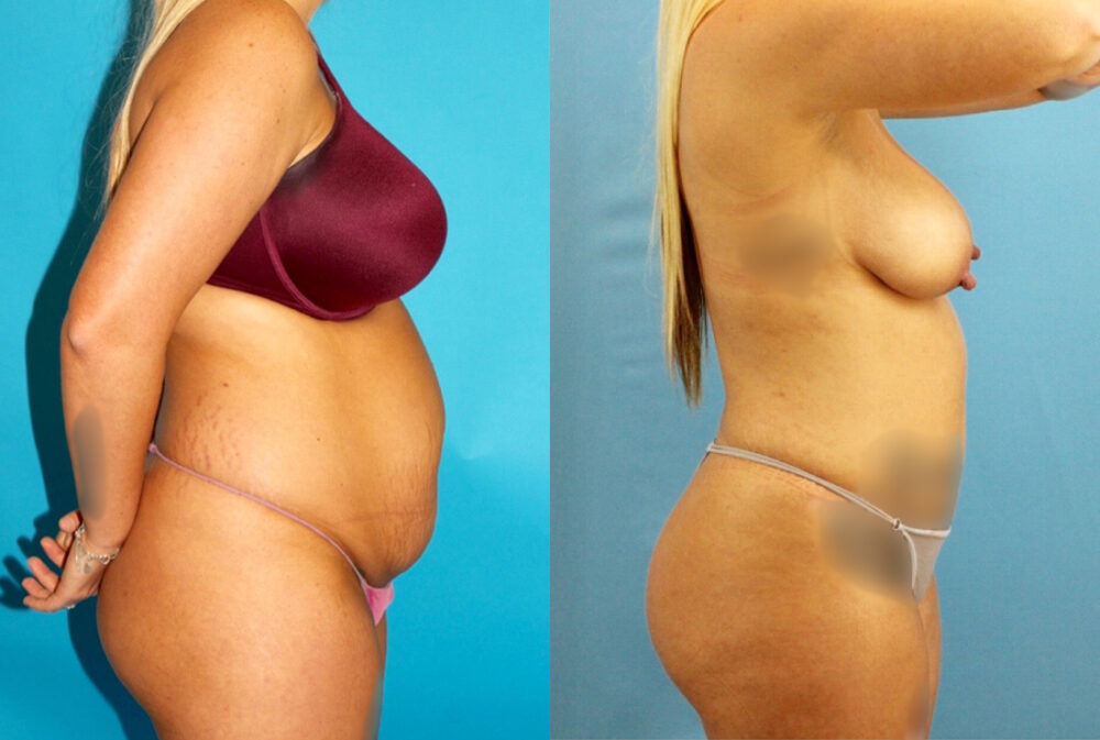 Tummy Tuck case #7344