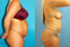 Tummy Tuck case #7344 slider thumbnail
