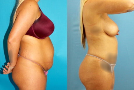 Tummy Tuck case #7344