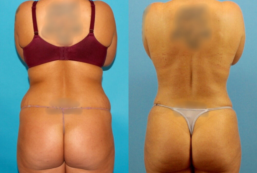Tummy Tuck case #7344
