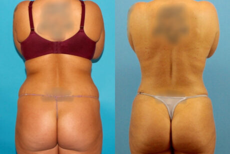 Tummy Tuck case #7344