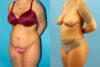 Tummy Tuck case #7344 slider thumbnail