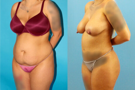 Tummy Tuck case #7344
