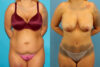 Tummy Tuck case #7344 slider thumbnail
