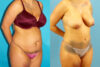 Tummy Tuck case #7344 slider thumbnail