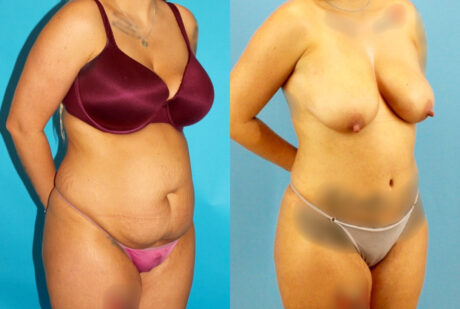 Tummy Tuck case #7344