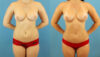 Brazilian Butt Lift case #4905 slider thumbnail