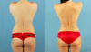 Brazilian Butt Lift case #4905 slider thumbnail
