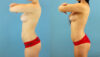 Brazilian Butt Lift case #4905 slider thumbnail