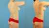 Brazilian Butt Lift case #4905 slider thumbnail