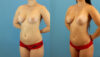 Brazilian Butt Lift case #4905 slider thumbnail