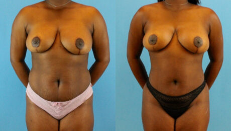 Brazilian Butt Lift case #4904