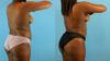 Brazilian Butt Lift case #4904 slider thumbnail