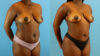 Brazilian Butt Lift case #4904 slider thumbnail